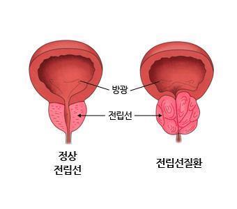 전립선 비대증, 전립선암 위험과 무관＂