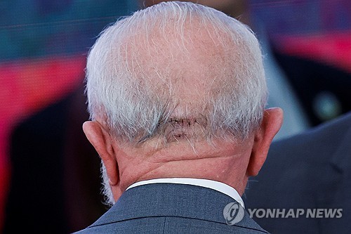 브라질 룰라 대통령 뇌출혈로 수술신경 기능 정상