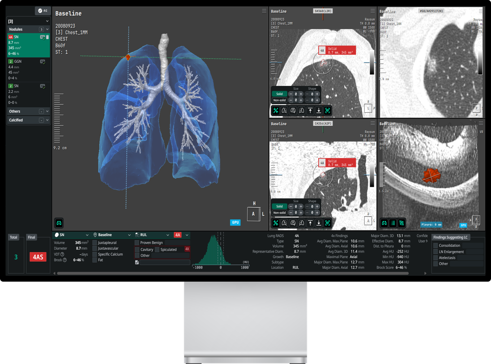 코어라인소프트의 AVIEW 설루션 화면.