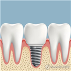임플란트,무허가,유통