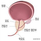 로봇수술,수술,전립선암,개복수술