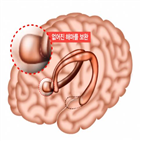 해마,절제,수술,기억,기능