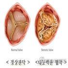 대동맥,레브렉스,협착,위험,선택