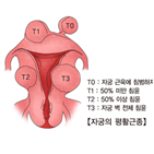 자궁근종,색전술,절제술,그룹