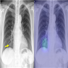 인공지능,시스템,질환,흉부
