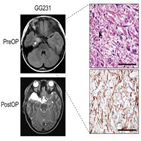 뇌종양,세포,연구,소아