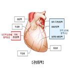 수치,관상동맥,좌심실,심부전,플라크