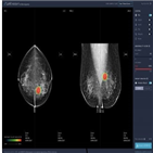 유방암,진단