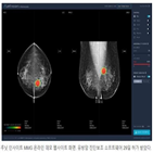 유방암,진단,유방,판독