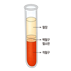 치매,헤모글로빈,빈혈,연구팀