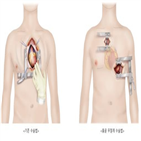 인공심장,흉골,절단