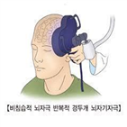 치료,환자,효과,우울증,연구팀