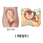 위험,비만,제왕절개,여성,분만,당뇨병