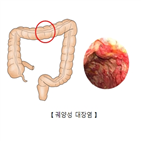 대장염,궤양성,증상,완화,효과