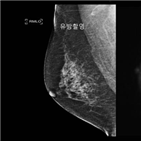 유방,유방암,확산강조,조영제