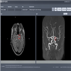 뇌동맥,인공지능,진단,질환,검출,소프트웨어