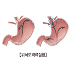 식도염,역류성,식도,효과,생활,습관