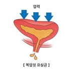 요실금,여성