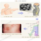 대상포진,합병증,치료,항바이러스제,그룹