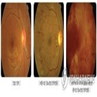 당뇨병성,망막병증,결과,진행,망막