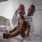 소말리아,영양실조,가뭄,사망자,최악,환자,우크라이나