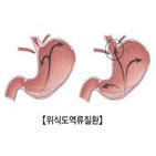 역류성,식도염,치주염,연구팀,결과
