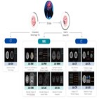 미국,솔루션,제이엘케이,뇌졸중,진출,신청,기업