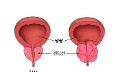 전립선비대증,치료제,탐스로신,시장,증가