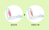 질환,루게릭병,증상,검사,진행,전문의,징후,운동신경세포,아래운동신경세포