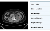 요로결석,아이도트,검출,교수팀,인공지능,위치