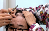 탈모,모발,최양락,원인,최근,치료