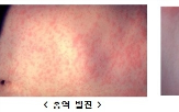 홍역,환자,올해,감염,베트남,접종,백신