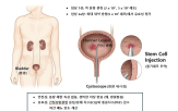 치료제,미래셀바이오,병변,최초,환자,이번,간질성방광염