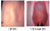 홍역,환자,해외,국가