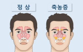 그룹,수술,항생제,부비강,만성,부비동염,증상