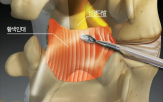 디스크,추간공,신경,통증,탈출,허리,방향,증상,압박