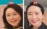 얼굴,수술,윤영미,지속,피부