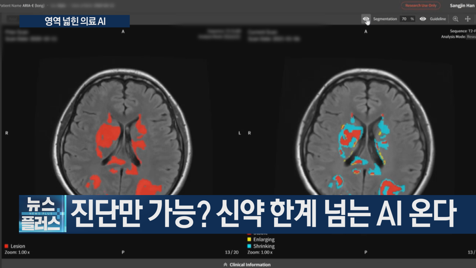 의료,부작용,신약,치료제,환자,치매