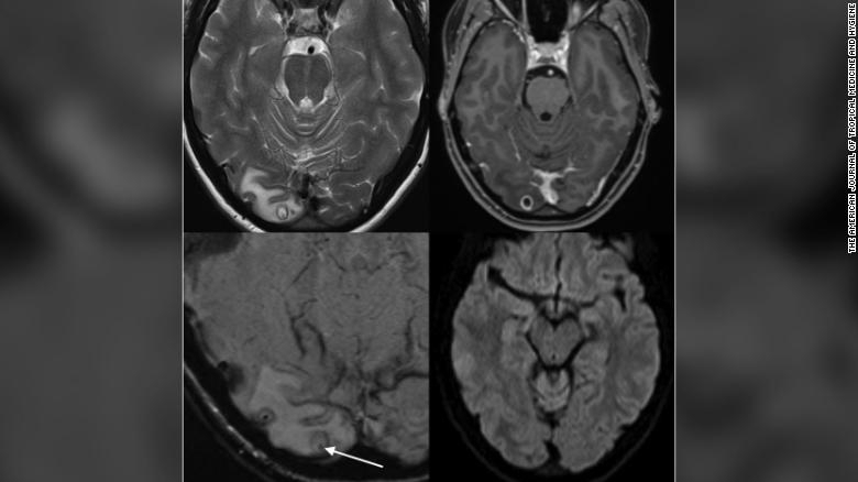 뇌에서 기생충이 발견된 A씨의 MRI 영상 (AJTMH 제공)