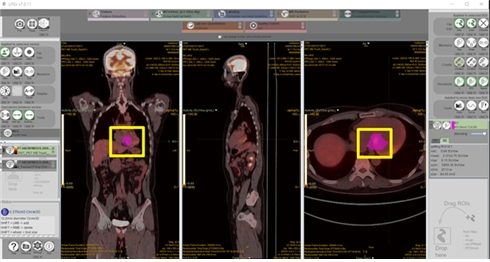 환자의 FDG PET-CT 영상 라벨링 작업을 위한 저작도구 화면(제공 : 에이아이더뉴트리진)
