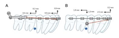 하악지 플레이트(A)를 이용한 교정의 치열 후방 이동량이 미니 임플란트(B)보다 두 배가 컸다.