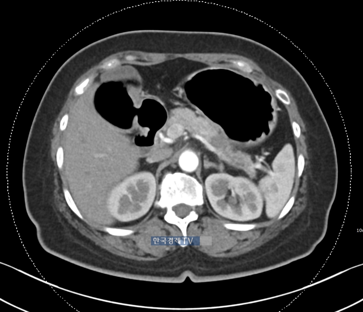 실제 췌장암 환자의 CT 사진. 오른쪽 상단에 1.6cm 크기의 병변이 있다. 