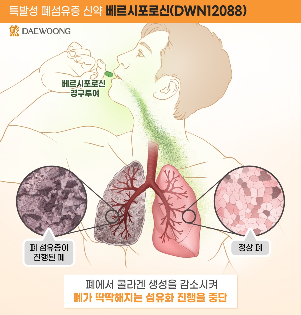 대웅제약 베르시포로신(DWN12088) 작용 기전. (사진=대웅제약)