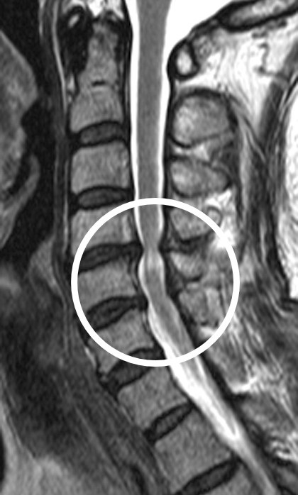 경추척수증 환자의 MRI.